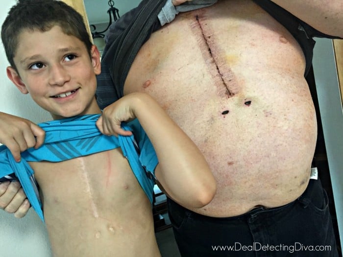 Male child holding up his blue shirt to show a healed heart surgery scar and an adult male doing the same with a fresh heart surgery scar.
