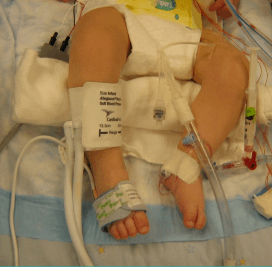 Small baby hooked up to multiple medical monitors and tubes on a hospital bed.